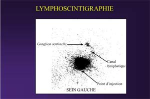 Lymphoscintigraphie